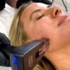 Will a Morpheus8 Treatment Leave You Bruised and Swollen