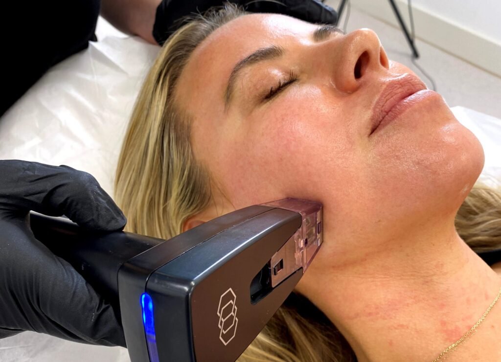 Will a Morpheus8 Treatment Leave You Bruised and Swollen